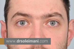 آیا کاشت ابرو برای آقایان خوب است؟