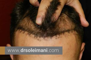 مراحل قبل و بعد از کاشت مو در کلینیک دکتر سلیمانی