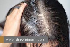 ریزش مو بر اثر تغییرات هورمونی