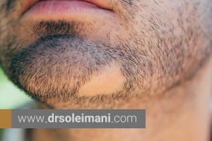 علت ریزش مو در ناحیه ریش و سبیل یا طاسی های ناحیه ای