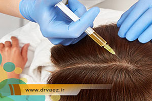 درمان ریزش مو به روش PRP