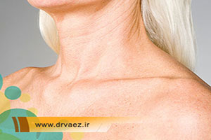 روشهای جوانسازی پوست گردن