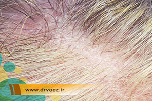 چه چیزی باعث آتروفی پوست سر میشود؟