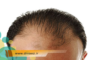 علت ریزش مو در مردان چیست و چگونه درمان میشود؟