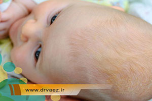 دلیل پوسته ریزی سر نوزاد چیست؟