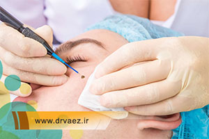 برداشتن خال در اصفهان با دستگاه های پیشرفته در کلینیک دکتر واعظ