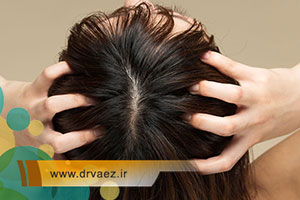 درمان ریزش مو در اصفهان | روش ها و هزینه تقویت و رفع ریزش مو