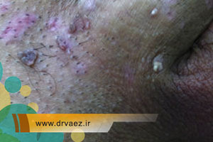 درمان زگیل تناسلی با کرایوتراپی | بررسی تاثیر کرایو زگیل تناسلی