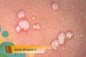 همه چیز درباره زگیل تناسلی در مردان و زنان | انواع زگیل تناسلی