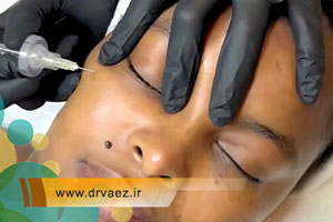 آیا کربوکسی تراپی برای لک صورت موثر است؟