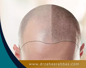 Hair transplantation