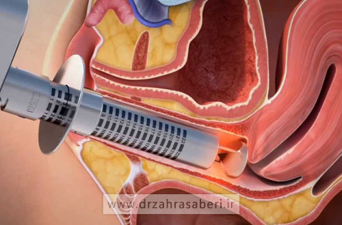 عوارض آر اف واژینال؛ آیا این روش بی خطر است؟