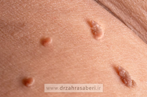 درمان زگیل تناسلی در اصفهان توسط دکتر متخصص زنان