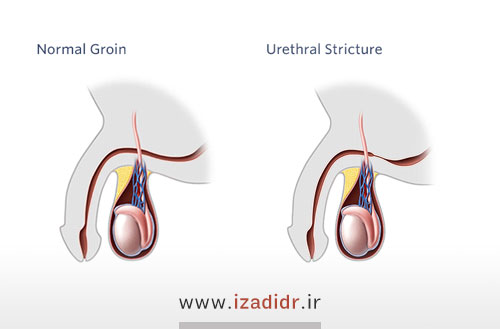 تنگی مجرای ادرار در مردان؛ علل علائم و درمان