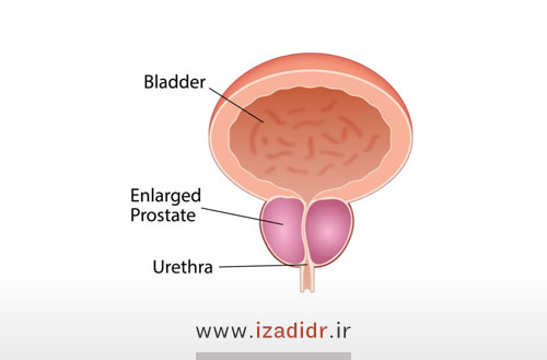 دلیل بزرگ شدن پروستات؛ بررسی علائم و روش درمان