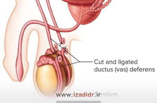انواع روشهای درمان آزواسپرمی انسدادی در مردان