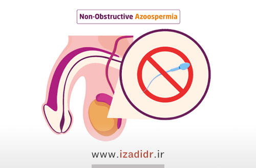 انواع روشهای درمان آزواسپرمی غیر انسدادی