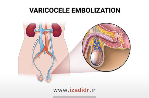 عمل جراحی واریکوسلکتومی یا واریکوسل چیست؟