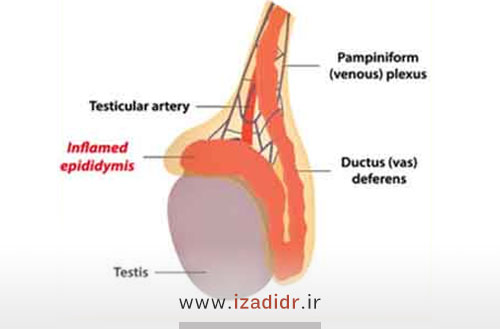 عفونت بیضه یا اپیدیدیمیت؛ علل و درمان آن