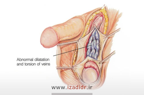 واریکوسل گرید سه | بارداری با واریکوسل گرید 3 امکانپذیر است؟