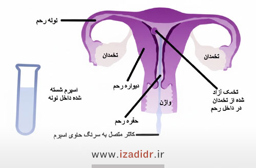 IUI چیست و ای یو ای موفق چه علائمی دارد؟