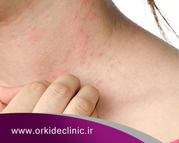 حساسیت پوستی چیست و روش های درمان آن کدام است؟