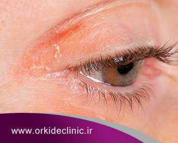 رایج ترین بیماری های پوستی دور چشم چیست؟