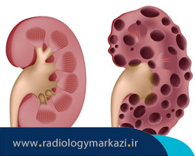 درمان کیست کلیه به وسیله پزشک رادیولوژیست
