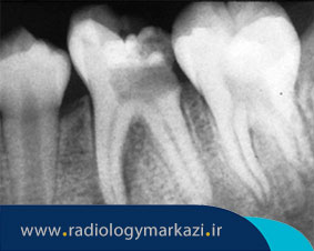 روش های فیلمبرداری از دندان با پری اپیکال