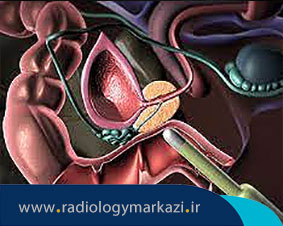 نمونه برداری از پروستات چگونه انجام میشود؟