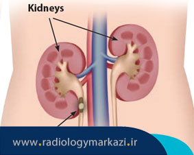 تشخیص سنگ کلیه از مسیر حالب به مثانه با عکس رنگی کلیه