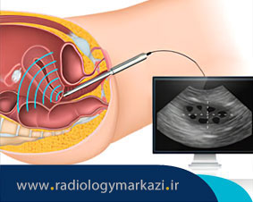 چگونی انجام سونوگرافی واژینال