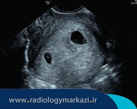 تشخیص بارداری یک یا چند قلویی با سونوگرافی