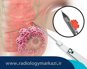 علت انجام بیوپسی یا نمونه برداری از پستان چیست؟