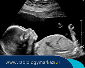 بررسی سقط جنین با سونوگرافی