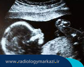 آیا سقط جنین در سونوگرافی مشخص می شود؟