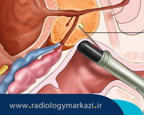 سونوگرافی پروستات چیست و چرا انجام می شود؟
