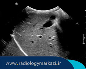 آندوسکوپی سونوگرافی دستگاه گوارش چیست و چگونه انجام می شود؟