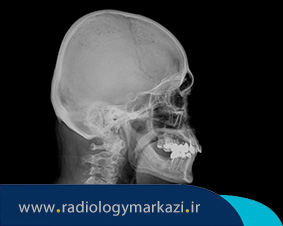 رادیوگرافی جمجمه چیست و چرا انجام میشود؟