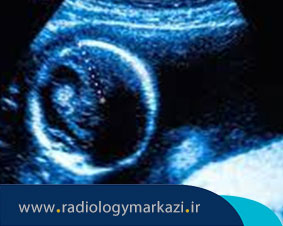تشخیص حاملگی پوچ با سونوگرافی