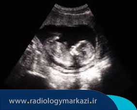 بررسی سقط جنین با سونوگرافی