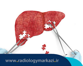اهمیت بیوپسی کبد در انتخاب بهترین روش درمان سرطان کبد