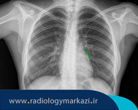 آشنایی مختصر با رادیوگرافی قفسه سینه