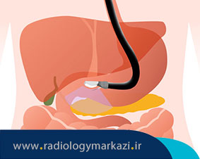 اندوسونوگرافی چگونه انجام میشود؟