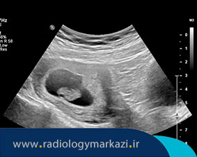 سونوگرافی تشخیص سن حاملگی در هفته چندم انجام میشود؟