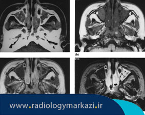 ارزیابی سینوسهای ماگزیلاری با رادیوگرافی جهت تشخیص سینوزیت