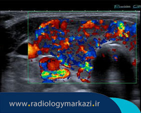 سونوگرافی داپلر تیروئید چه کاربردی دارد؟