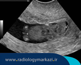 لزوم انجام سونوگرافی بعد از سقط