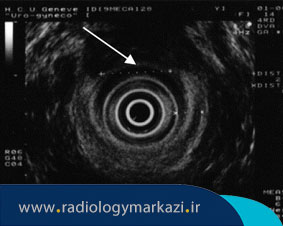 کاربرد سونوگرافی مقعدی چیست و به چه دلیل انجام میشود؟