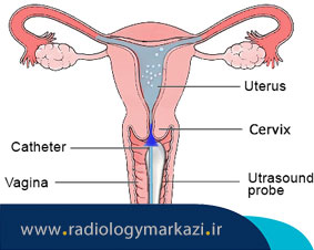 هیستروسونوگرافی چیست و چگونه انجام میشود؟